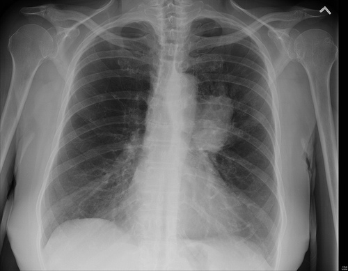 Anvisa aprova primeira terapia específica para tratamento da